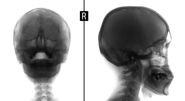 X-ray film na twarzy - czołowej, nos, podbródek i boczne projekcji. Wielkość formacji zatoki szczękowej prawej. Znacznik. Ujemny. — Zdjęcie stockowe