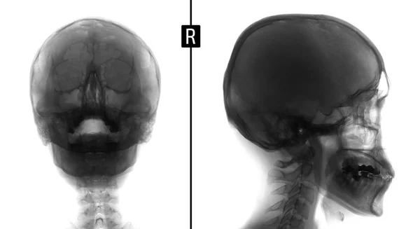 X-ray film na twarzy - czołowej, nos, podbródek i boczne projekcji. Wielkość formacji zatoki szczękowej prawej. Ujemny. — Zdjęcie stockowe