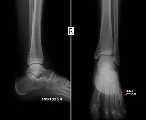 Radiographie de la cheville. Montre le kyste osseux du cinquième doigt du pied droit. Marqueur . — Photo