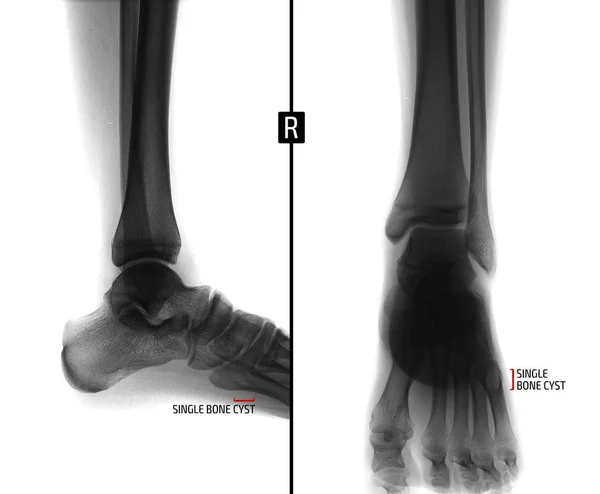 Radiografía de la articulación del tobillo. Muestra el quiste óseo del quinto dedo del pie derecho. Marcador. Negativo. . — Foto de Stock