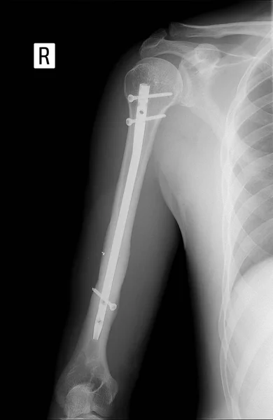 Røntgen av høyre overarm. Viser den konsoliderte frakturen i høyre overarm med metallarbeider . – stockfoto