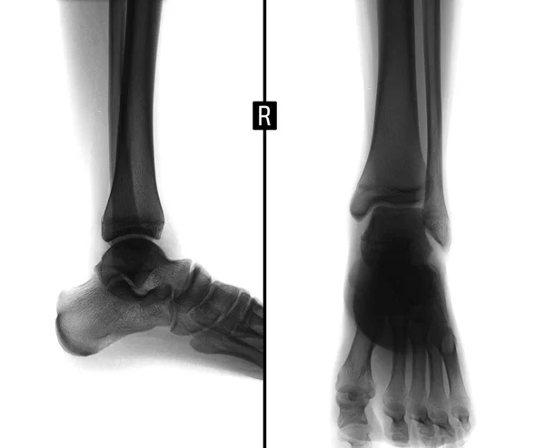 X-ray hlezenního kloubu. Zobrazí kostní cysta pátého prstu pravé nohy. Negativní. — Stock fotografie