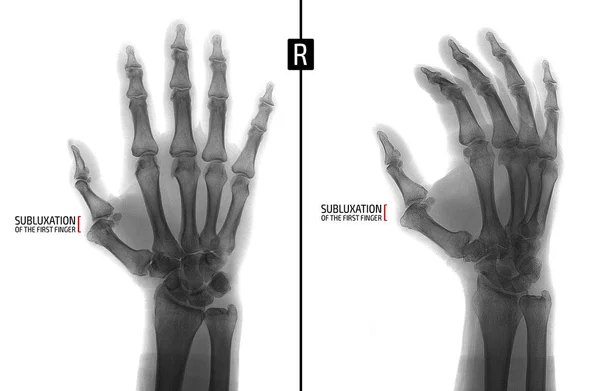 X-ışını el. Sağ elin ilk parmak proksimal falanks subluksasyon gösterir. İşaret. Negatif. — Stok fotoğraf