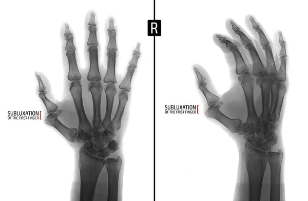 Rentgen ruky. Ukazuje, subluxace proximální falangy prstu pravé ruky. Značka. Negativní. — Stock fotografie