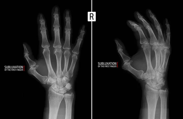 Radiografía de la mano. Muestra la subluxación de la falange proximal del primer dedo de la mano derecha. Marcador . — Foto de Stock