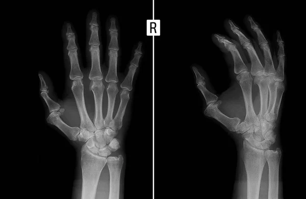 Radiografía de la mano. Muestra la subluxación de la falange proximal del primer dedo de la mano derecha . — Foto de Stock