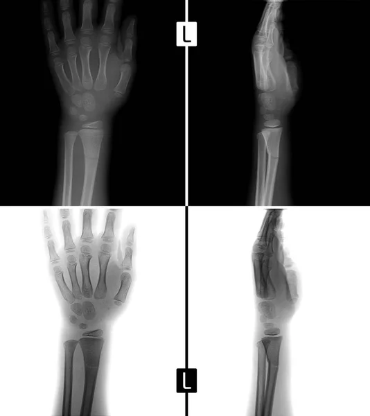 X-ışını el. Çocuğun sol kaval Subperiosteal kırılması gösterir. Olumlu. Negatif. — Stok fotoğraf