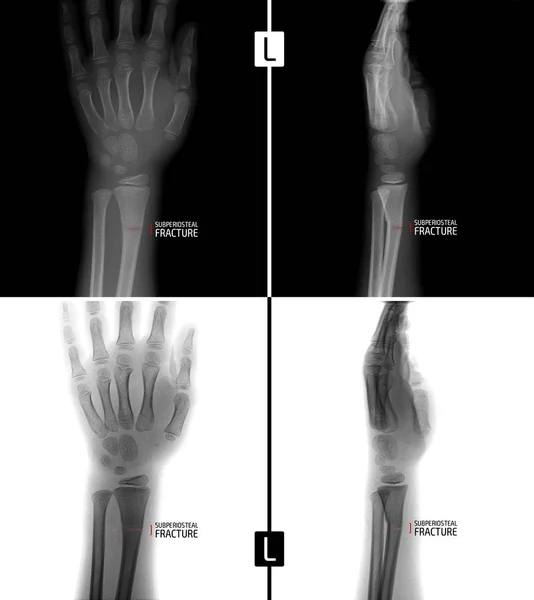 Рентген руки. Показывает субпериостеальный перелом левого радиуса ребенка. Маркер. Абсолютно. Отрицательно . — стоковое фото