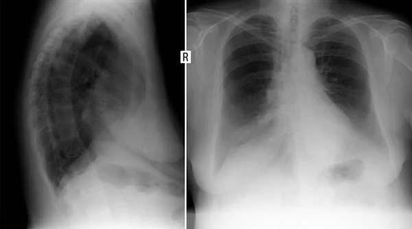 Radiographie pulmonaire. Affiche la formation de volume du poumon droit . — Photo