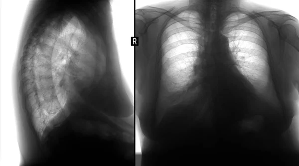 Röntgenlunge. zeigt die Volumenbildung der rechten Lunge. negativ. — Stockfoto