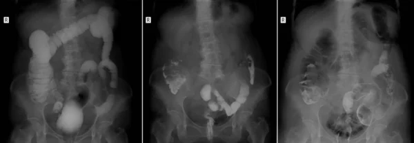 Gastrointestinal sistem (GI) alt kısımlarında X-Ray. Sıkı doldurma. Boşaltma. Hava üfleme. Patoloji.