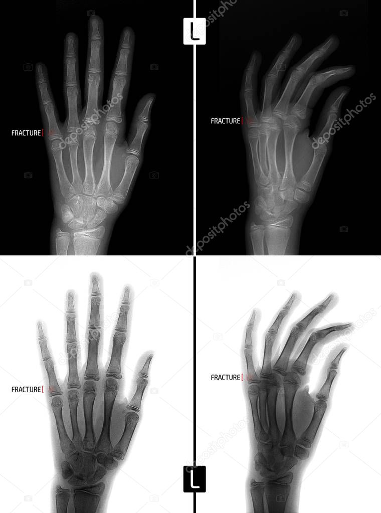 Normal left hand x ray Xray of the hand. Shows the Fracture of the