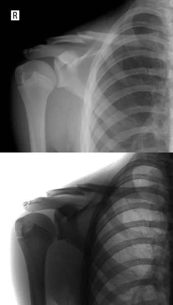 Sağ köprücük röntgeni. Çocuğun köprücük kemiği kırığı. Olumlu. Negatif. — Stok fotoğraf