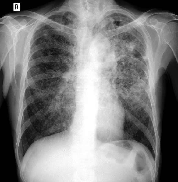 Rentgen Plic Miliární Tuberkulóza — Stock fotografie