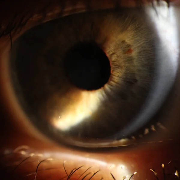 enlarged image of an eye iris made with a slit lamp