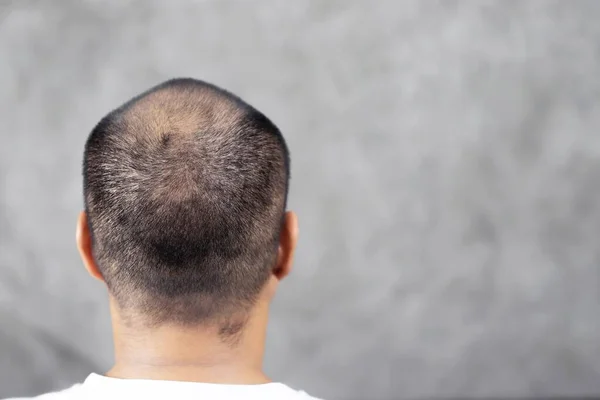 Glatzköpfe Haarausfall Starker Stress — Stockfoto