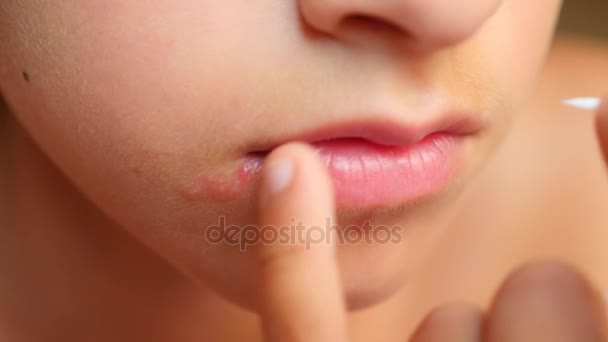 Jongen zweertjes op de lippen aan te raken. herpes. lip behandeling. 4k, slow-motion-video schieten, ruimte kopiëren — Stockvideo
