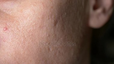 küresel Kistik akne cilt üzerinde. Yakın çekim. Dermatoloji kavramı. 4k, ağır çekim. kopya alanı