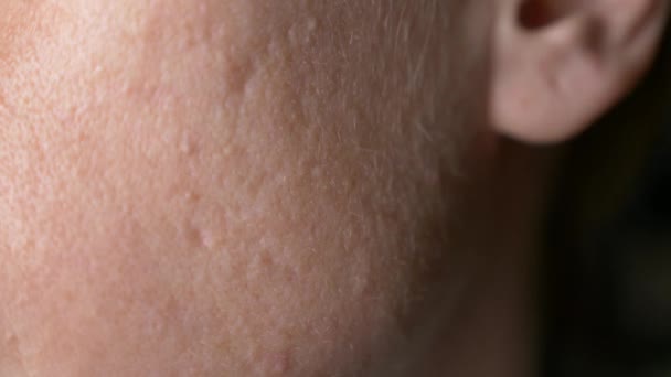 Sferische cystic acne op de huid. Close-up. Het concept van Dermatologie. 4k, slow-motion. kopie ruimte — Stockvideo