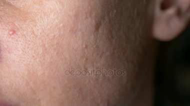 küresel Kistik akne cilt üzerinde. Yakın çekim. Dermatoloji kavramı. 4k, ağır çekim. kopya alanı