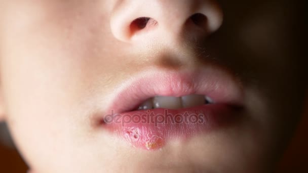 Herpes op de lippen van een jongen. herpes. lip behandeling. 4k, slow-motion-video schieten, ruimte kopiëren — Stockvideo