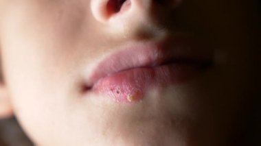 bir çocuğun dudaklarında uçuk. uçuk. dudak tedavisi. 4k, ağır çekim silah, uzay kopyalama