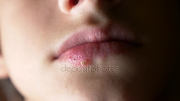 Herpes på läpparna av en pojke. herpes. läppbehandling. 4k, Slowmotion-skytte, kopiera utrymme — Stockvideo