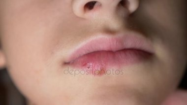 bir çocuğun dudaklarında uçuk. uçuk. dudak tedavisi. 4k, ağır çekim silah, uzay kopyalama