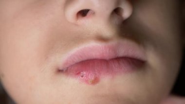 bir çocuğun dudaklarında uçuk. uçuk. dudak tedavisi. 4k, ağır çekim silah, uzay kopyalama