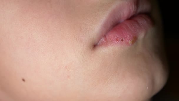 Herpes op de lippen van een jongen. herpes. lip behandeling. 4k, slow-motion-video schieten, ruimte kopiëren — Stockvideo