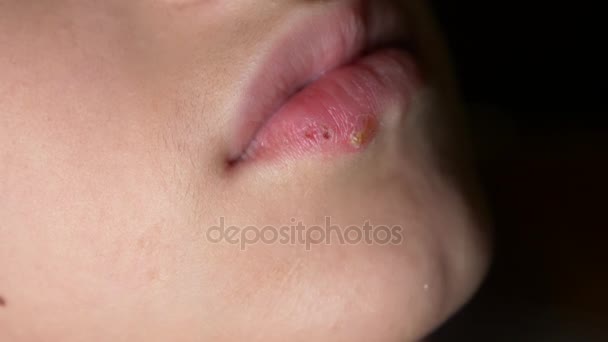 소년의 입술에 헤 르 페 스입니다. 헤 르 페 스입니다. 입술 치료입니다. 4 k, 슬로우 모션 촬영, 공간 복사 — 비디오