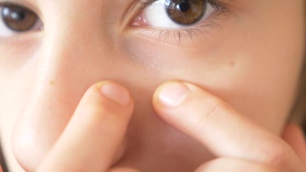 Eine Person mit einem Akne-Problem, aus nächster Nähe. Teenagerhaut, schwarze Punkte. 4k, Zeitlupe — Stockvideo
