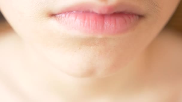 Een persoon met een acneprobleem, close-up. tiener huid, zwarte stippen. 4k, slow-motion — Stockvideo