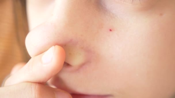 Uma pessoa com um problema de acne, close-up. Pele adolescente, pontos pretos. 4k, câmera lenta — Vídeo de Stock