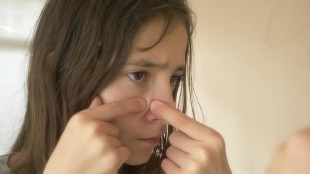 Uma pessoa com um problema de acne, close-up. Pele adolescente, pontos pretos. 4k, câmera lenta — Vídeo de Stock