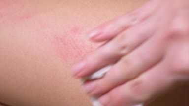 Yaralı diz çocuğun, kızlar tur sıyrıklar. yakın çekim. Hidrojen peroksit aşınma dökün. 4 k. ağır çekim