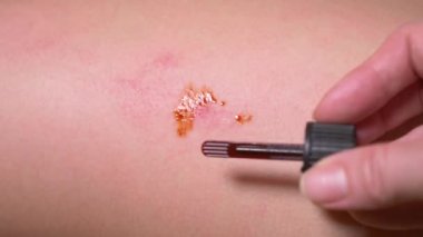 Yaralı diz çocuğun, kızlar tur sıyrıklar. yakın çekim. İyot aşınma dökün. 4 k. ağır çekim