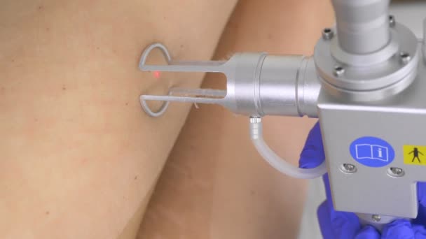 Een close-up. laser resurfacing van de huid van de voeten. laserverjonging — Stockvideo
