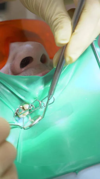 Detailní záběr. lékař zubař zachází se zuby trpělivý muž pomocí cofferdam — Stock fotografie