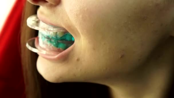 Close-up. Teeth whitening clinic. Girl with a drip in her mouth. — Stock Video