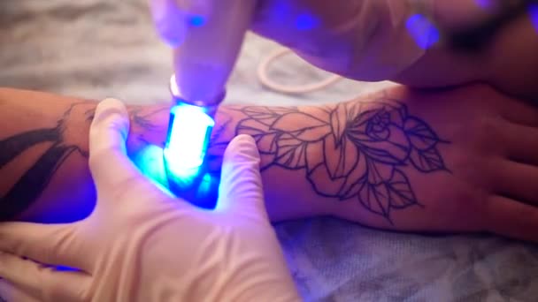 Láser de eliminación de tatuajes. Una joven se quita el tatuaje con un láser . — Vídeos de Stock