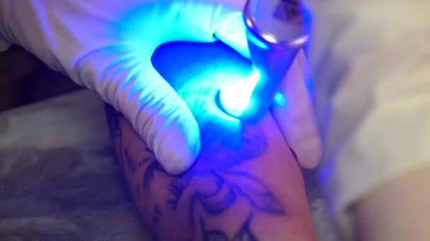 Лазер для удаления татуировок. Молодая девушка удаляет татуировку лазером . — стоковое видео