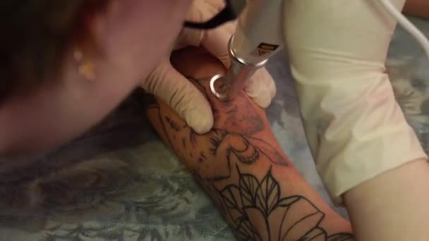 Láser de eliminación de tatuajes. Una joven se quita el tatuaje con un láser . — Vídeos de Stock