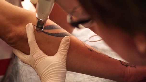 Laser de remoção de tatuagem. Uma jovem garota remove a tatuagem com um laser . — Vídeo de Stock