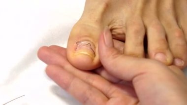 Batık ayak tırnaklarını tedavisinde. Batık tırnak. Doktor bir ayak hastalıkları uzmanı. Donanım pedikür. Podiatry.