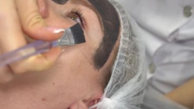 Karbon surat soyma prosedürü. Lazer darbeleri yüz derisini temizler. Donanım kozmetoloji tedavisi. Fototermoliz süreci, deriyi ısıtma, lazer karbon soyma. Yüz derisi