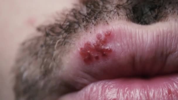 Mans labios con herpes. Vista frontal — Vídeo de stock