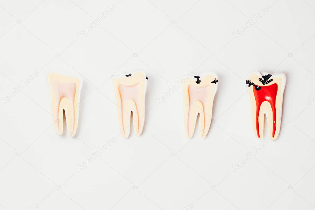Teeth molds showing the evolution of caries on white background