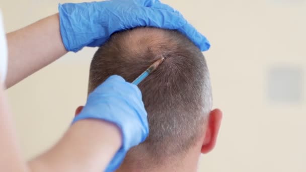 Haarmesotherapie of haartransplantatie: een schoonheidsspecialiste doet injecties in het hoofd van de man voor haargroei of om kaalheid te voorkomen — Stockvideo