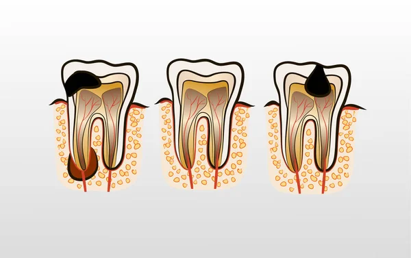 Ilustración vectorial de caries dental — Archivo Imágenes Vectoriales